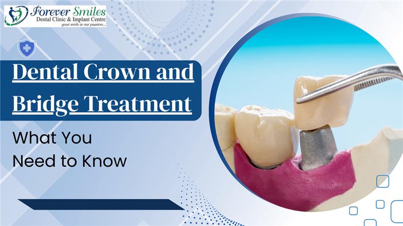 Understanding the Difference Between Crowns Vs. Veneers