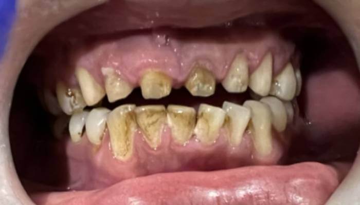 Patient 3 before treatment