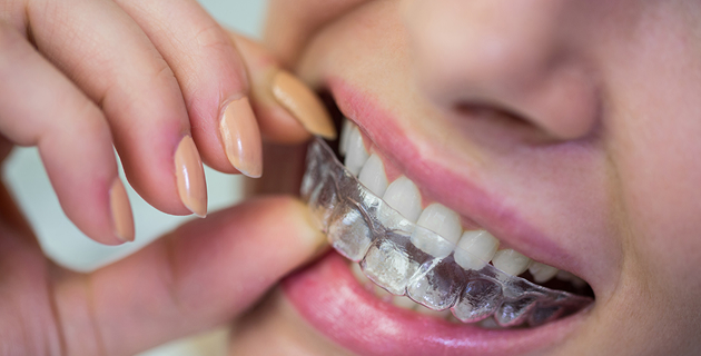 Dental aligners treatment